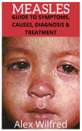Measles: Guide to Symptoms, Causes, Diagnosis & Treatment